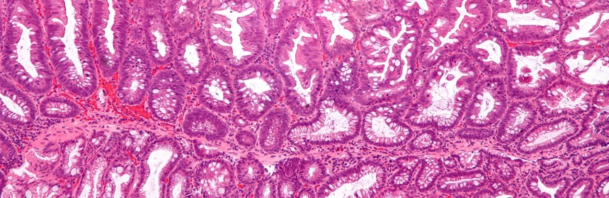 Micrograph of a stain of a portion of secum removed during a colonoscopy.